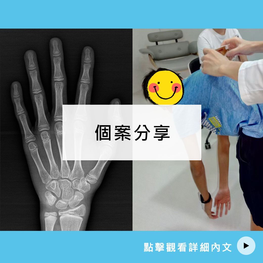 13歲 林弟弟長高案例分享-其他醫院骨齡判斷16歲